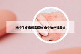 南寧牛皮癬哪家醫(yī)院 南寧治療銀屑病