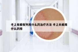 手上有癬有列用什么藥治療方法 手上長癬用什么藥擦