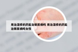 用治濕疹的藥能治銀屑病嗎 用治濕疹的藥能治銀屑病嗎女性