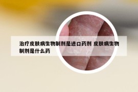 治療皮膚病生物制劑是進(jìn)口藥劑 皮膚病生物制劑是什么藥