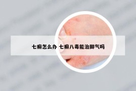 七癬怎么辦 七癬八毒能治腳氣嗎
