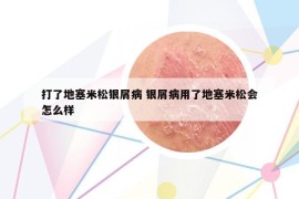 打了地塞米松銀屑病 銀屑病用了地塞米松會怎么樣