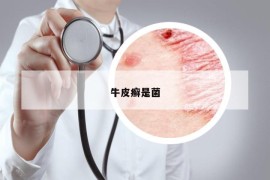 牛皮癬是菌