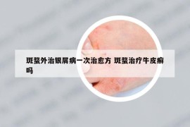 斑蝥外治銀屑病一次治愈方 斑蝥治療牛皮癬嗎