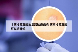 芃醫(yī)冷敷凝膠治掌跖膿皰病嗎 醫(yī)用冷敷凝膠可以消腫嗎
