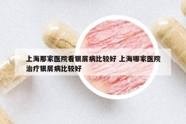 上海那家醫(yī)院看銀屑病比較好 上海哪家醫(yī)院治療銀屑病比較好