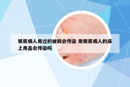 銀屑病人用過的被褥會傳染 用銀屑病人的床上用品會傳染嗎