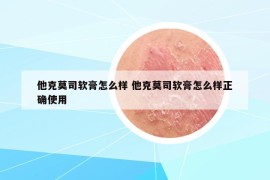 他克莫司軟膏怎么樣 他克莫司軟膏怎么樣正確使用