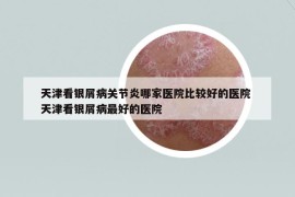 天津看銀屑病關(guān)節(jié)炎哪家醫(yī)院比較好的醫(yī)院 天津看銀屑病最好的醫(yī)院