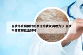 點(diǎn)狀牛皮癬要好的表現(xiàn)癥狀及調(diào)理方法 點(diǎn)狀牛皮皮癬能治好嗎
