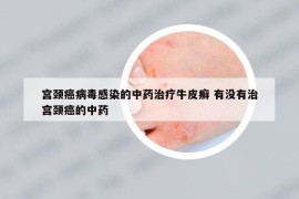 宮頸癌病毒感染的中藥治療牛皮癬 有沒有治宮頸癌的中藥