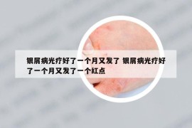 銀屑病光療好了一個(gè)月又發(fā)了 銀屑病光療好了一個(gè)月又發(fā)了一個(gè)紅點(diǎn)