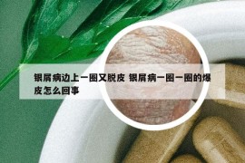 銀屑病邊上一圈又脫皮 銀屑病一圈一圈的爆皮怎么回事