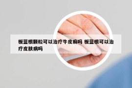 板藍(lán)根顆?？梢灾委熍Ｆぐ_嗎 板藍(lán)根可以治療皮膚病嗎