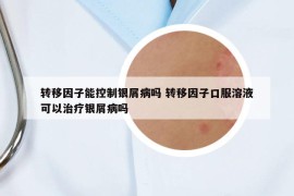 轉(zhuǎn)移因子能控制銀屑病嗎 轉(zhuǎn)移因子口服溶液可以治療銀屑病嗎