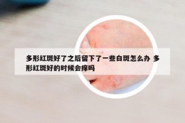 多形紅斑好了之后留下了一些白斑怎么辦 多形紅斑好的時候會癢嗎