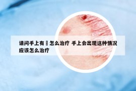 請問手上有廯怎么治療 手上會出現(xiàn)這種情況應該怎么治療