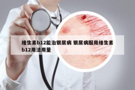 維生素b12能治銀屑病 銀屑病服用維生素b12用法用量