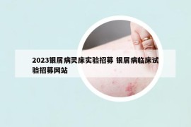 2023銀屑病靈床實驗招募 銀屑病臨床試驗招募網(wǎng)站