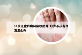11歲兒童白癜風(fēng)癥狀圖片 11歲小孩有白發(fā)怎么辦