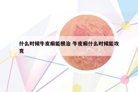 什么時(shí)候牛皮癬能根治 牛皮癬什么時(shí)候能攻克