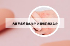 大面積皮癬怎么治療 大面積的癬怎么辦