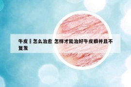 牛皮廯怎么治愈 怎樣才能治好牛皮癖并且不復(fù)發(fā)