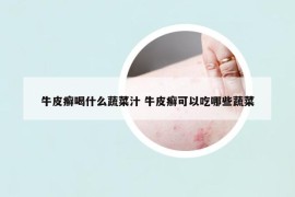 牛皮癬喝什么蔬菜汁 牛皮癬可以吃哪些蔬菜