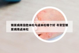 銀屑病用倍他米松與鹵米松哪個好 尋常型銀屑病用鹵米松