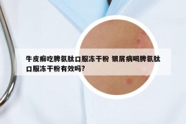 牛皮癬吃脾氨肽口服凍干粉 銀屑病喝脾氨肽口服凍干粉有效嗎?