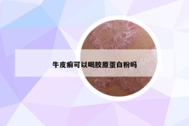 牛皮癬可以喝膠原蛋白粉嗎