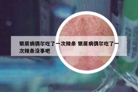 銀屑病偶爾吃了一次辣條 銀屑病偶爾吃了一次辣條沒事吧