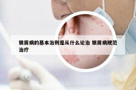 銀屑病的基本治則是從什么論治 銀屑病規(guī)范治療