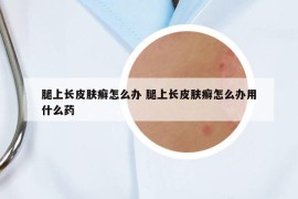 腿上長皮膚癬怎么辦 腿上長皮膚癬怎么辦用什么藥