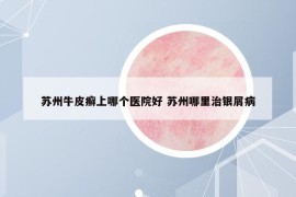 蘇州牛皮癬上哪個(gè)醫(yī)院好 蘇州哪里治銀屑病