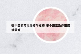 哪個(gè)國家可以治療牛皮癬 哪個(gè)國家治療銀屑病最好