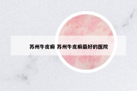 蘇州牛皮癬 蘇州牛皮癬最好的醫(yī)院