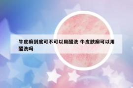 牛皮癬到底可不可以用醋洗 牛皮膚癬可以用醋洗嗎