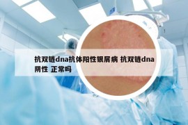 抗雙鏈dna抗體陽性銀屑病 抗雙鏈dna陰性 正常嗎