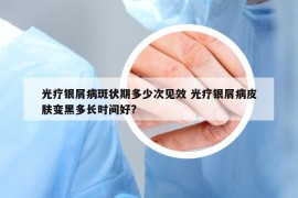 光療銀屑病斑狀期多少次見效 光療銀屑病皮膚變黑多長時(shí)間好?