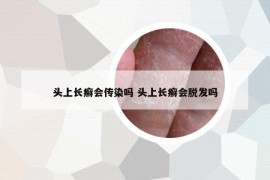 頭上長癬會傳染嗎 頭上長癬會脫發(fā)嗎