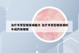 治療尋常型銀屑病偏方 治療尋常型銀屑病的中成藥有哪些