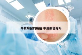 牛皮癬留的癬疤 牛皮癬留疤嗎