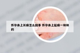 懷孕身上長癬怎么回事 懷孕身上起癬一塊塊的