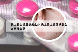 頭上臉上銀屑病怎么辦 頭上臉上銀屑病怎么辦用什么藥