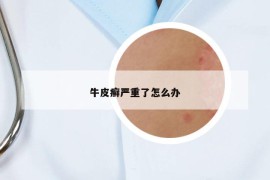 牛皮癬嚴重了怎么辦