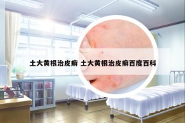 土大黃根治皮癬 土大黃根治皮癬百度百科