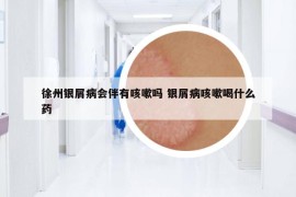 徐州銀屑病會伴有咳嗽嗎 銀屑病咳嗽喝什么藥