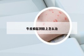 牛皮癬起到臉上怎么治