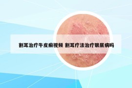 割耳治療牛皮癬視頻 割耳療法治療銀屑病嗎
